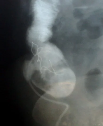 SMALL BOWEL TEXTILOMA