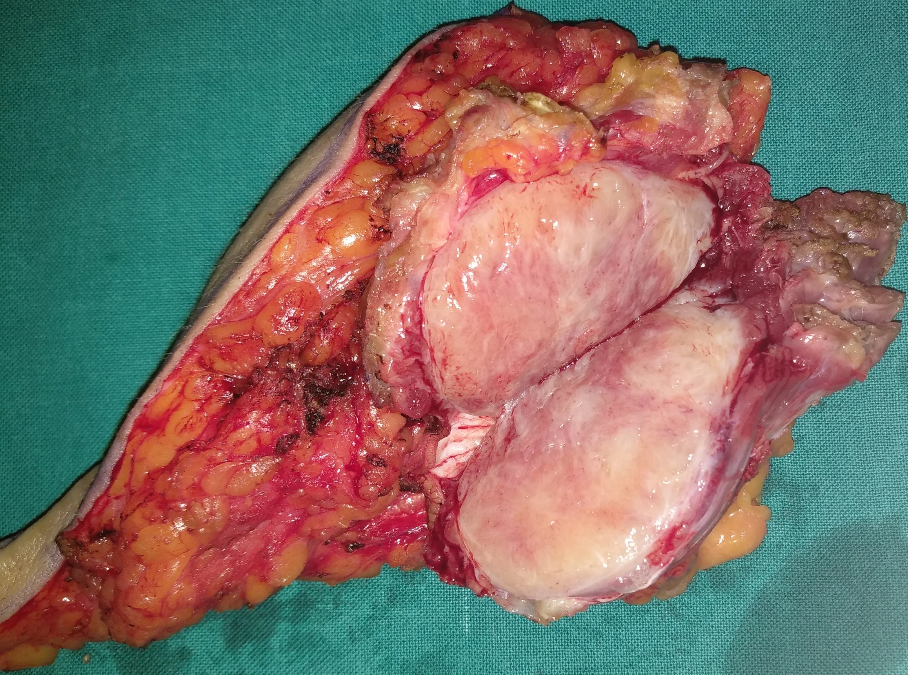 DESMOID TUMOR INGUINAL REGION
