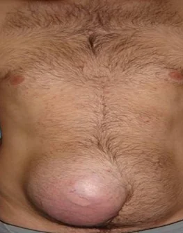 ABDOMINAL DESMOID TUMOR
