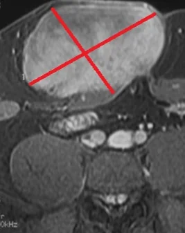 ABDOMINAL DESMOID TUMOR - CT SCAN