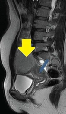 ABDOMINAL WALL DESMOID TUMOR