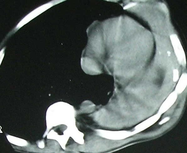 CHEST WALL DESMOID TUMOR