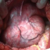 DESMOID TUMOR