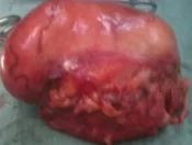 EXCISED CHEST WALL DESMOID TUMOR 