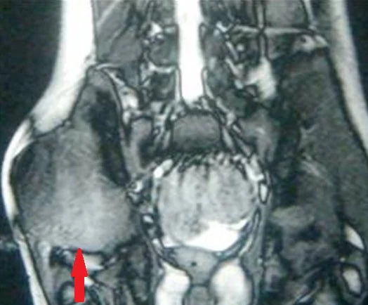 DESMOID TUMOR RIGHT BUTTOCK