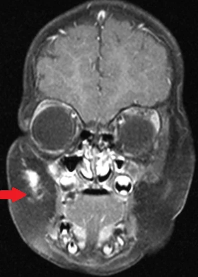 DESMOID TUMOR RIGHT CHEEK