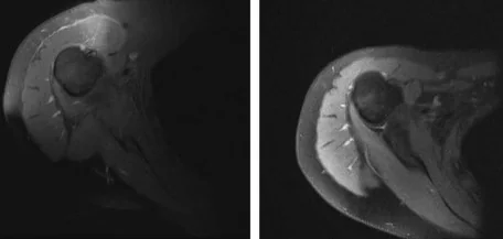 DESMOID TUMOR DELTOID MUSCLE
