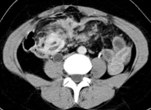 MESOGASTRIUM DESMOID TUMOR