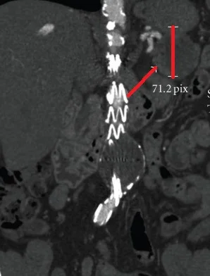 DESMOID TUMOR - PANCREAS