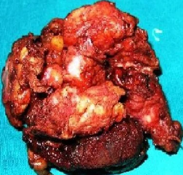 DESMOID TUMOR POPLITEAL FOSSA