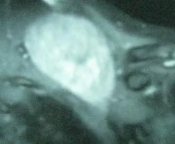 SUPRACLAVICULAR DESMOID TUMOR