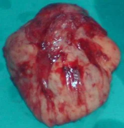 SUPRACLAVICULAR DESMOID TUMOR SPECIMEN