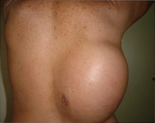 CHEST WALL DESMOID TUMOR