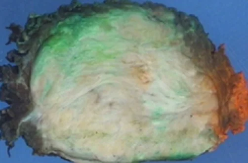 EXTRA-ABDOMINAL DESMOID TUMOR