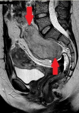 PRESACRAL DESMOID TUMOR