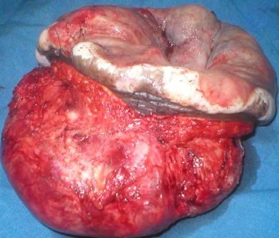 MASSIVE ABDOMINAL WALL DESMOID TUMOR