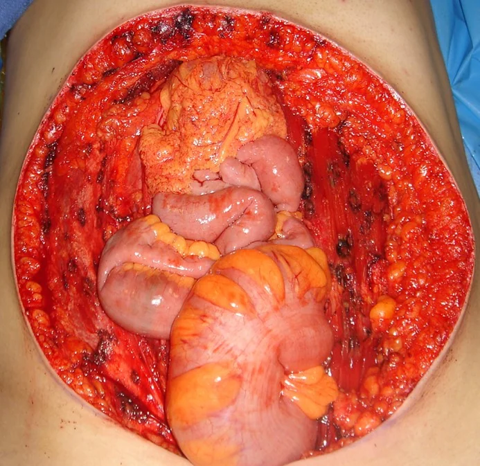 EXCISED HUGE PERIUMBILICAL DESMOID TUMOR