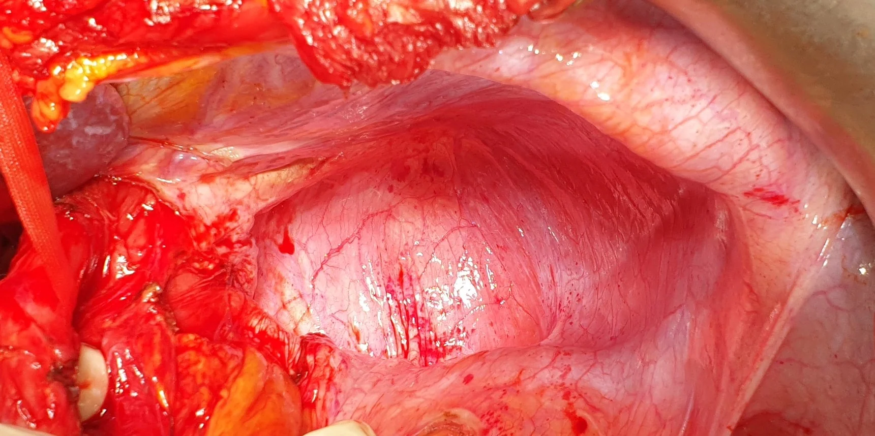 EVENTRATION LEFT HEMI-DIAPHRAGM