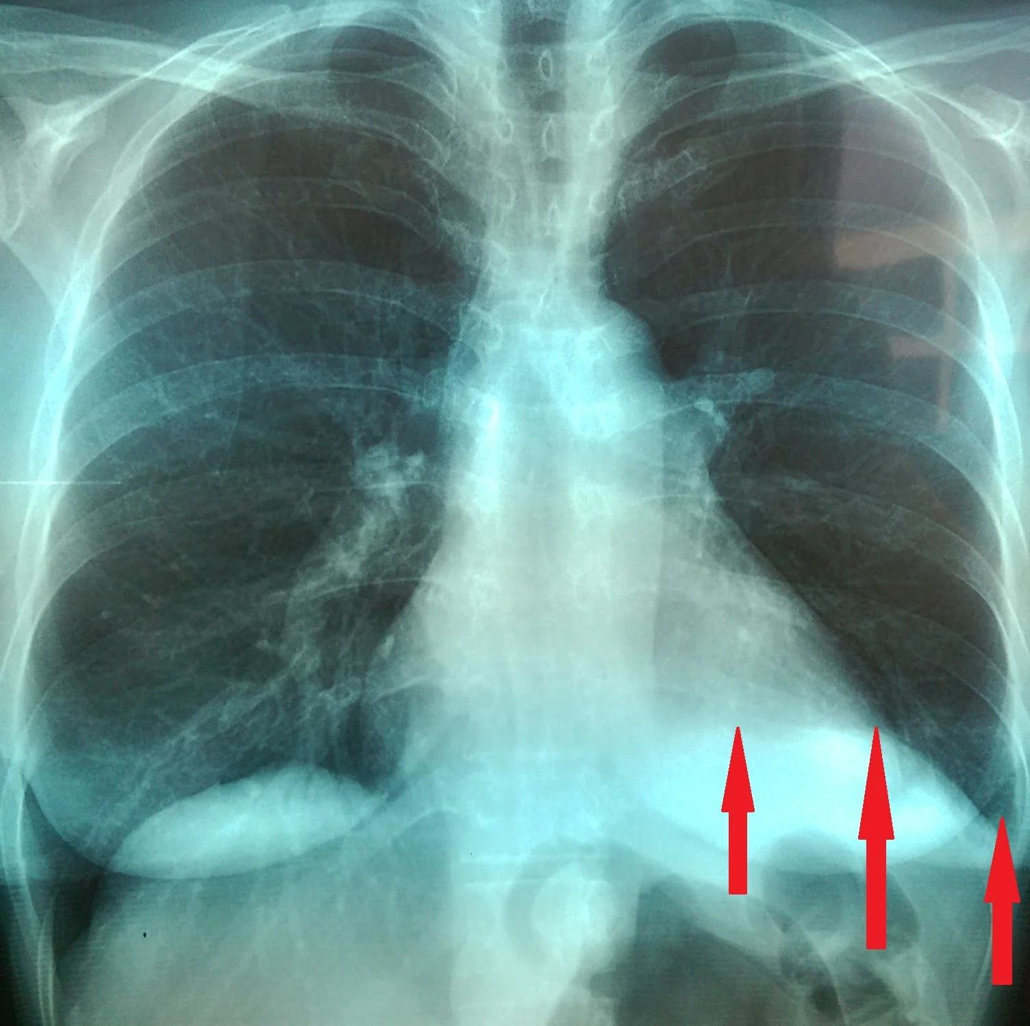 EVENTRATION REPAIR - POST OP CHEST X - RAY