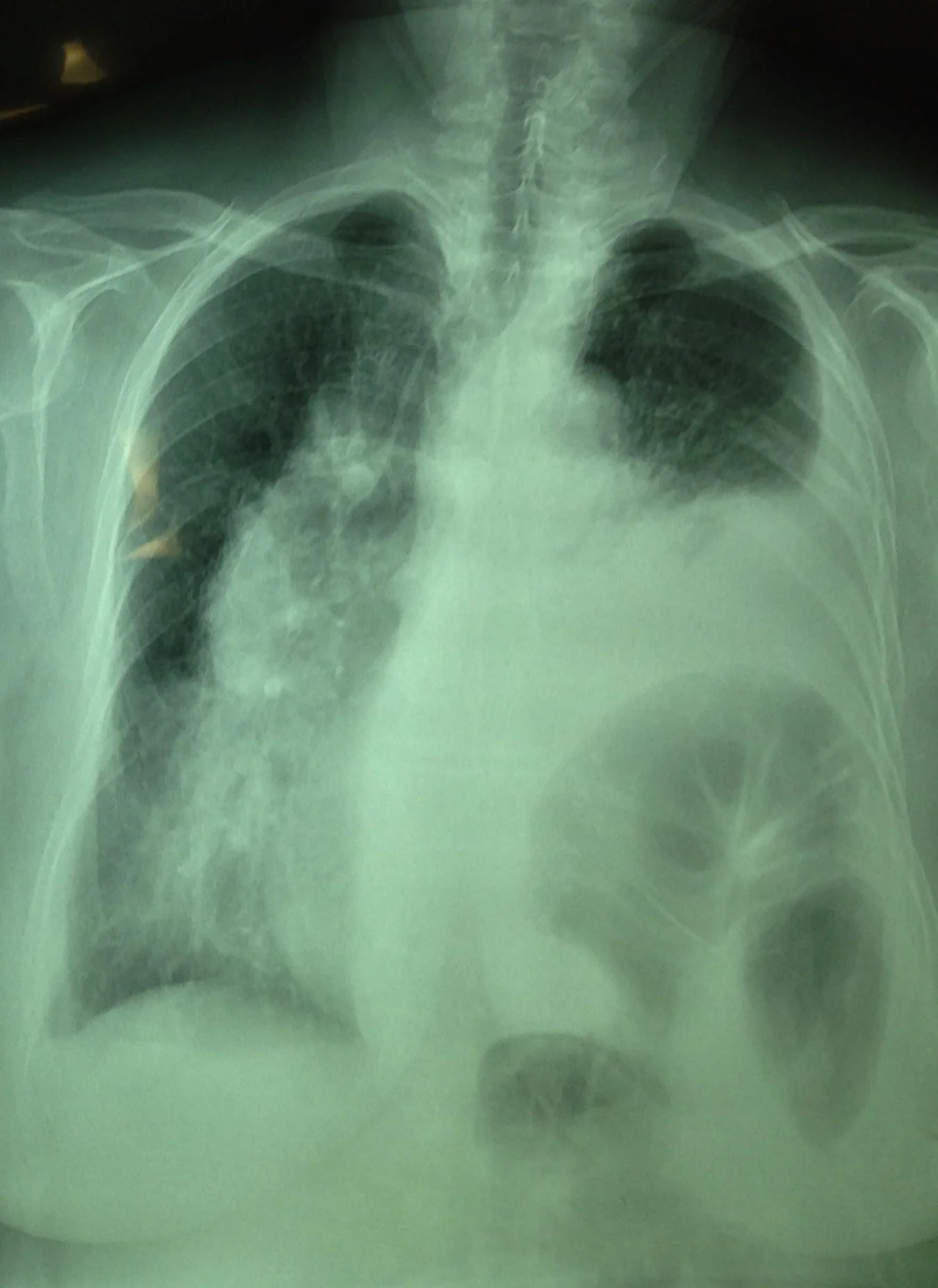 LEFT HEMI-DIAPHRAGM HYPOPLASIA