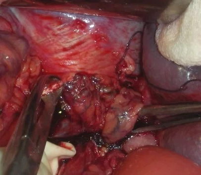 ADULT INCARCERATED BOCHDALEK HERNIA  