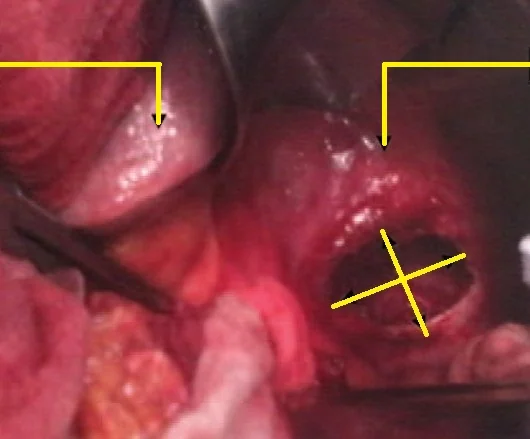 ADULT BOCHDALEK HERNIA