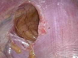 ADULT BOCHDALEK HERNIA