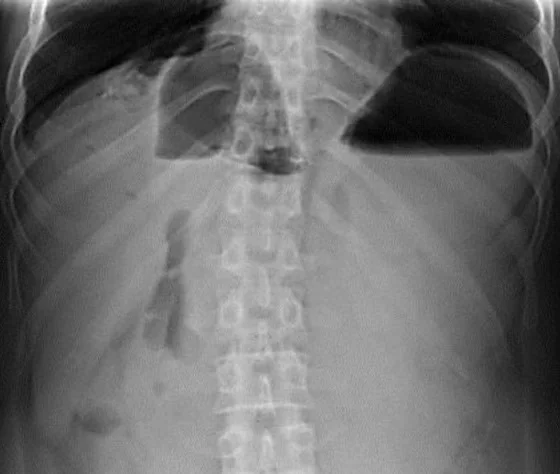 INCARCERATED BOCHDALEK HERNIA - ABDOMINAL X - RAY