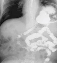 BOCHDALEK HERNIA - BARIUM STUDY