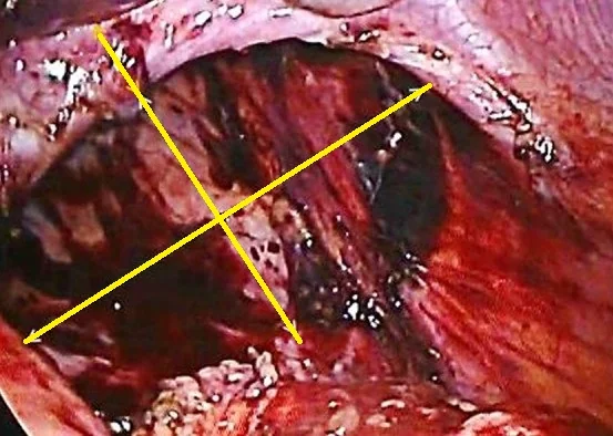 ADULT BOCHDALEK HERNIA