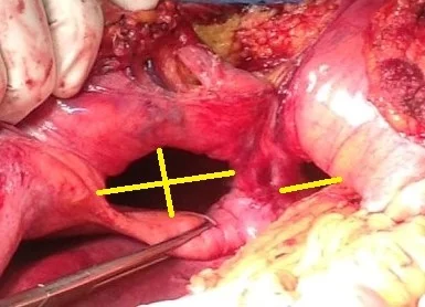 CONGENITAL BILATERAL DIAPHRAGMATIC HERNIAS