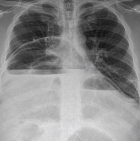 CONGENITAL BILATERAL DIAPHRAGMATIC HERNIAS - CHEST X - RAY