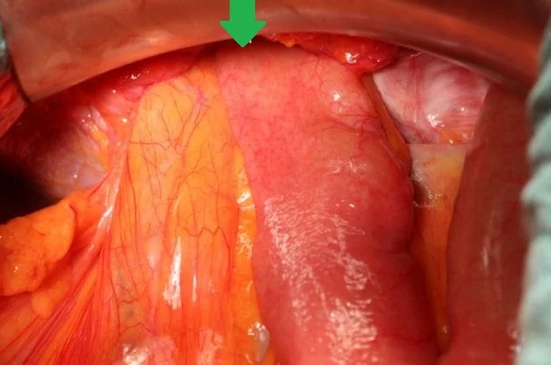 ENTEROTHORAX