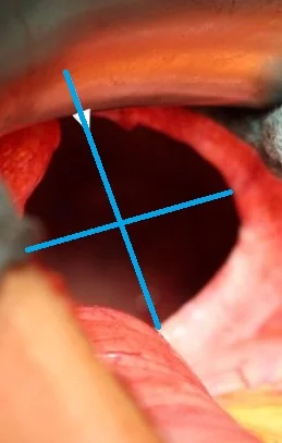 REDUCTION OF THE ENTEROTHORAX