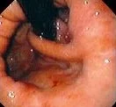 PARAESOPHAGEAL HIATAL HERNIA