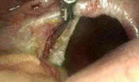 HIATAL HERNIA - LAPAROSCOPIC IMAGE