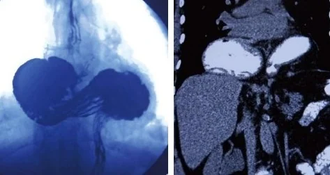 HIATAL HERNIA - MRI