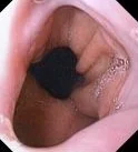 HIATAL HERNIA - ENDOSCOPY IMAGE