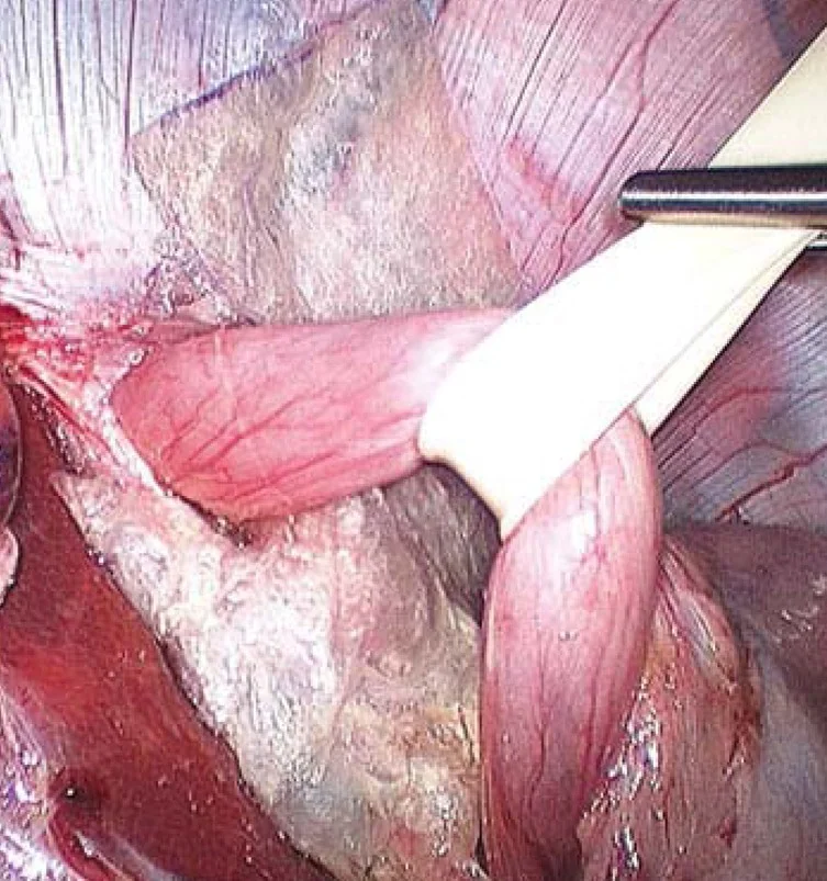 HIATAL HERNIA REPAIR