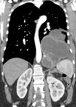 HIATAL HERNIA - MRI