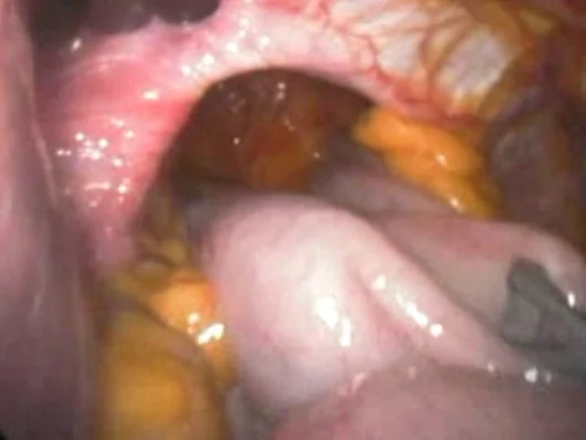 HIATAL HERNIA
