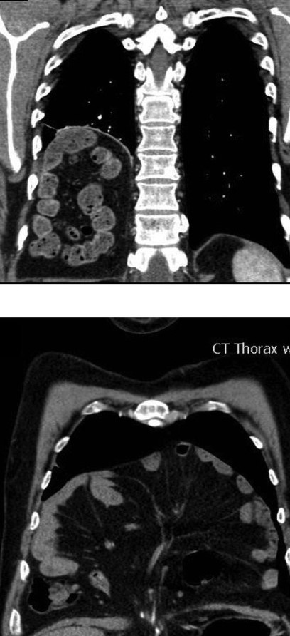MORGAGNI HERNIA - CT THORAX
