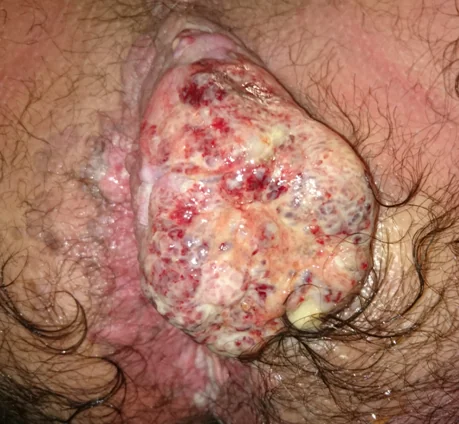 BUSCHKE LOWENSTEIN TUMOR