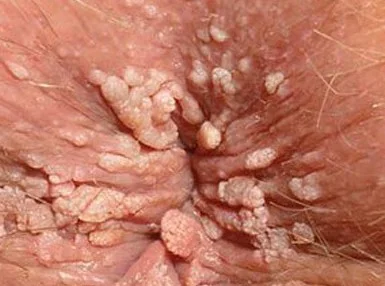 ANAL WARTS