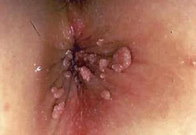 ANAL WARTS