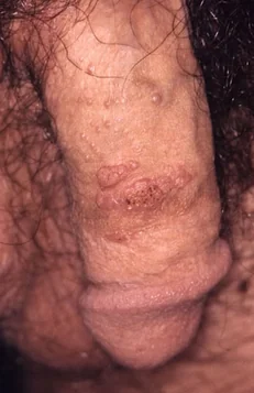 GENITAL WARTS