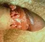 GENITAL WARTS