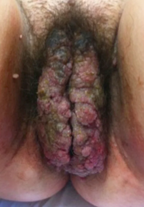 VULVAR CONDYLOMATA