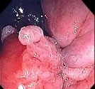 RECTAL KONDYLOMATA