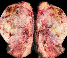 CROSS SECTION SACRAL CHORDOMA